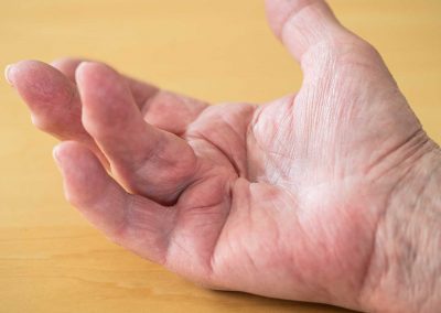 Dupuytren Kontraktur